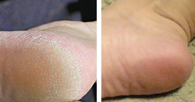 Bathefex Softsole Exfoliating Foot Peel